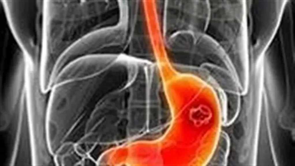 فصيلة دم واحدة قد تزيد خطر الإصابة بسرطان المعدة.. ماذا يقول العلم؟