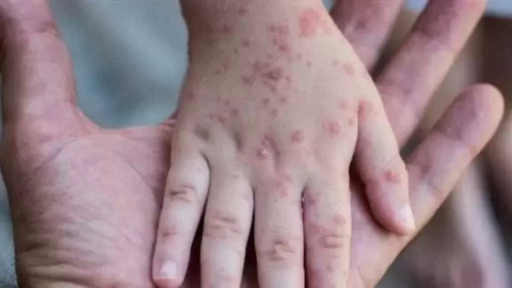 ارتفاع حالات الإصابة بالحصبة إلى 700 شخص في ولاية كارولاينا الجنوبية بأمريكا