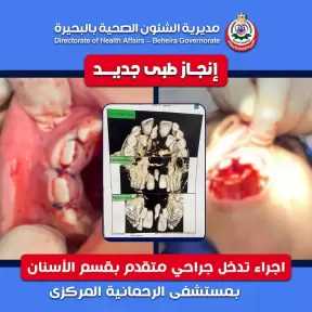 تدخل جراحي متقدم بقسم الأسنان بمستشفى الرحمانية المركزي ينهي معاناة طفل من سن زائد مدفون بالفك العلوي