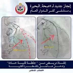اجراء 5 عمليات قسطرة قلبية بمستشفى كفر الدوار العام فى يوم واحد