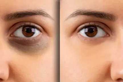 الهالات السوداء لا ترتبط دائمًا بقلة النوم.. 8 أسباب وراء ظهورها